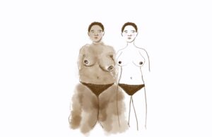 Sisters not twins illustration of how my surgeon sees me vs. how I actually look
